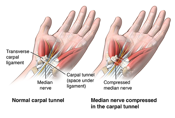 carpal tunnel sindrome