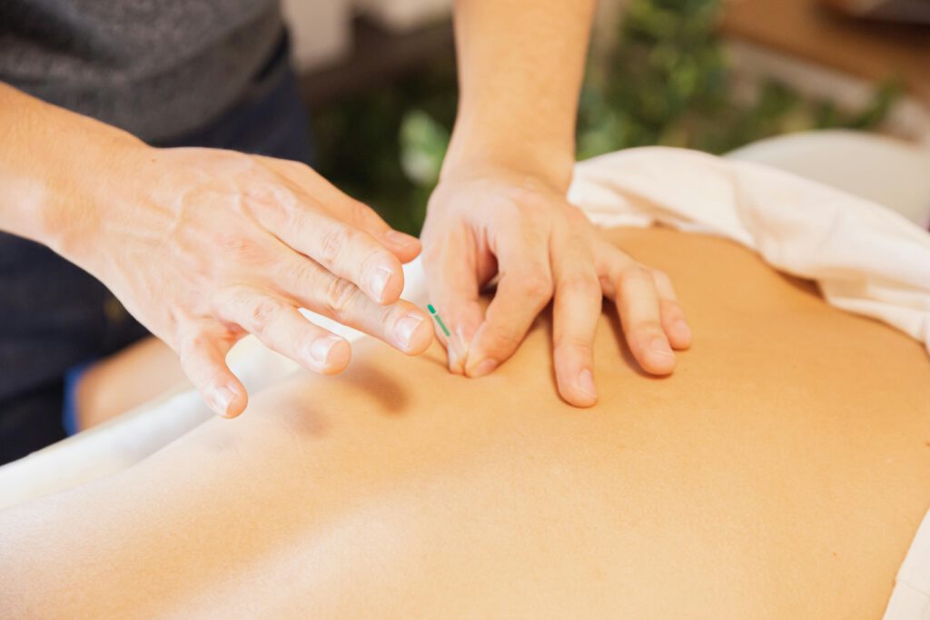 Acupuncture in Etobicoke